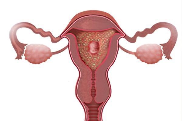 amenaza de aborto tratamiento