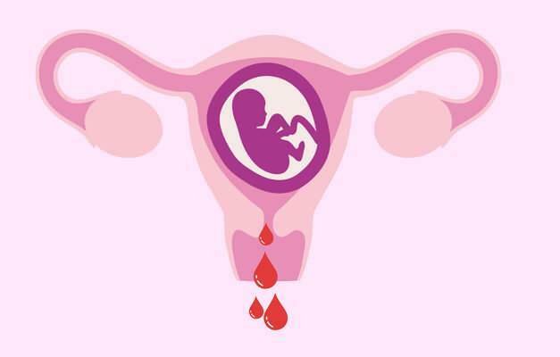 amenaza de aborto