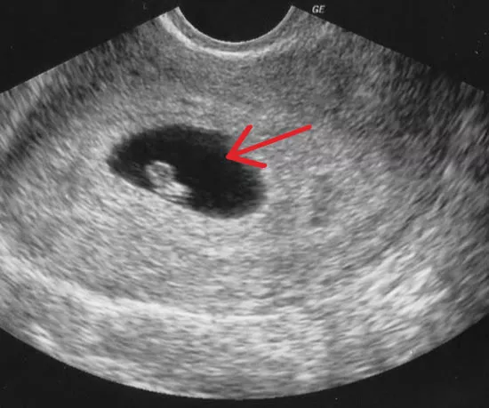 cual es el ultrasonido obstetrico