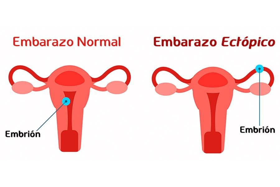 embarazo ectopico que es